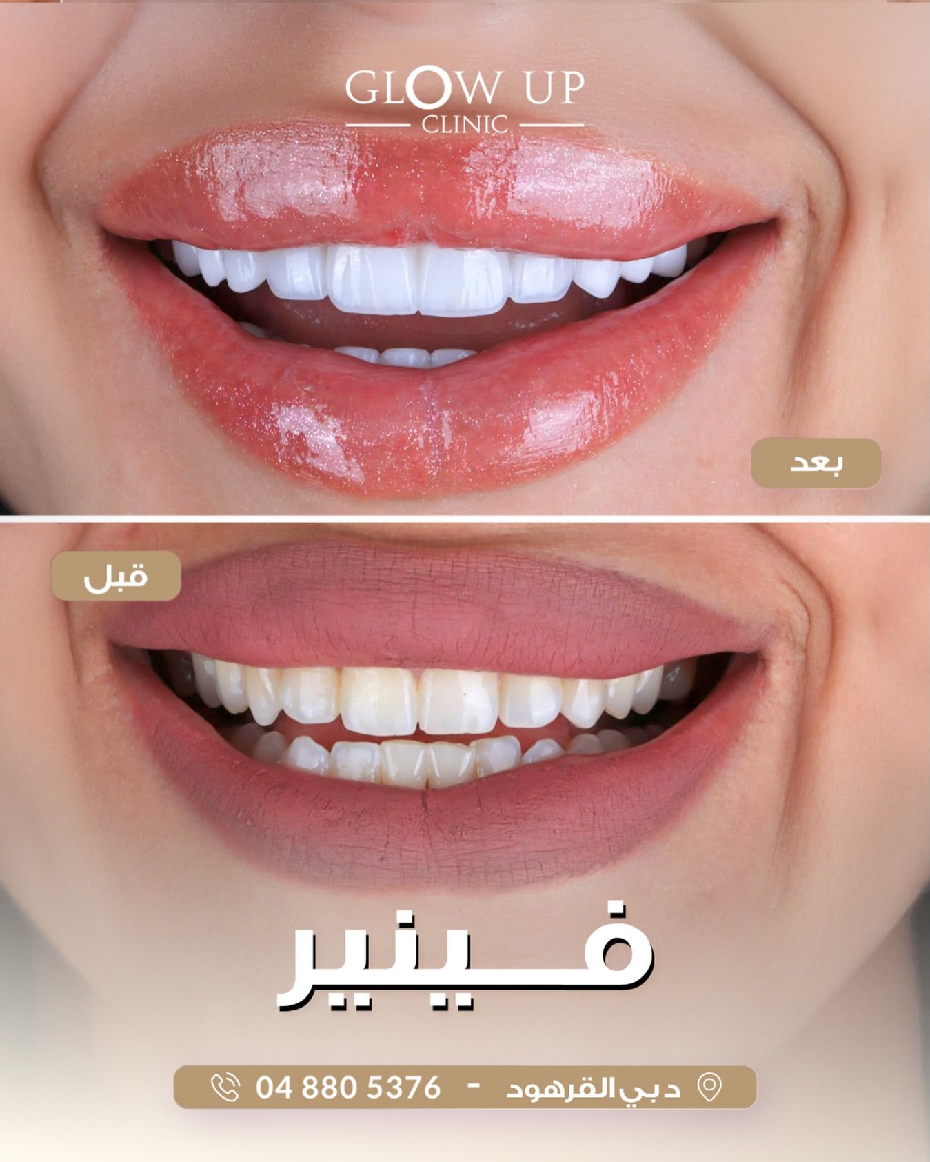 ابتسامة هوليوود - قبل وبعد - عيادة جلو أب