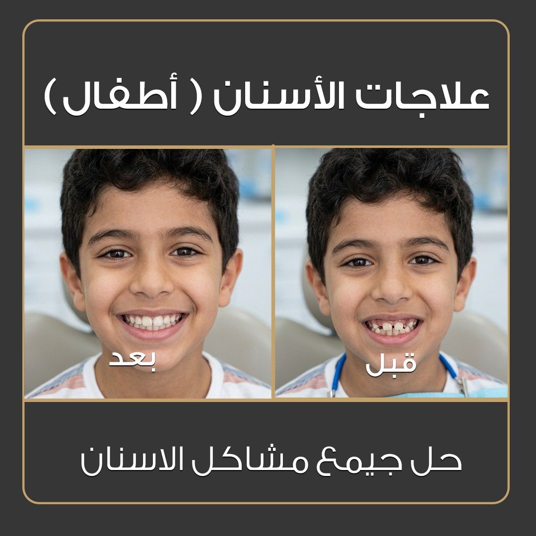 ابتسامة هوليوود - قبل وبعد - عيادة جلو أب