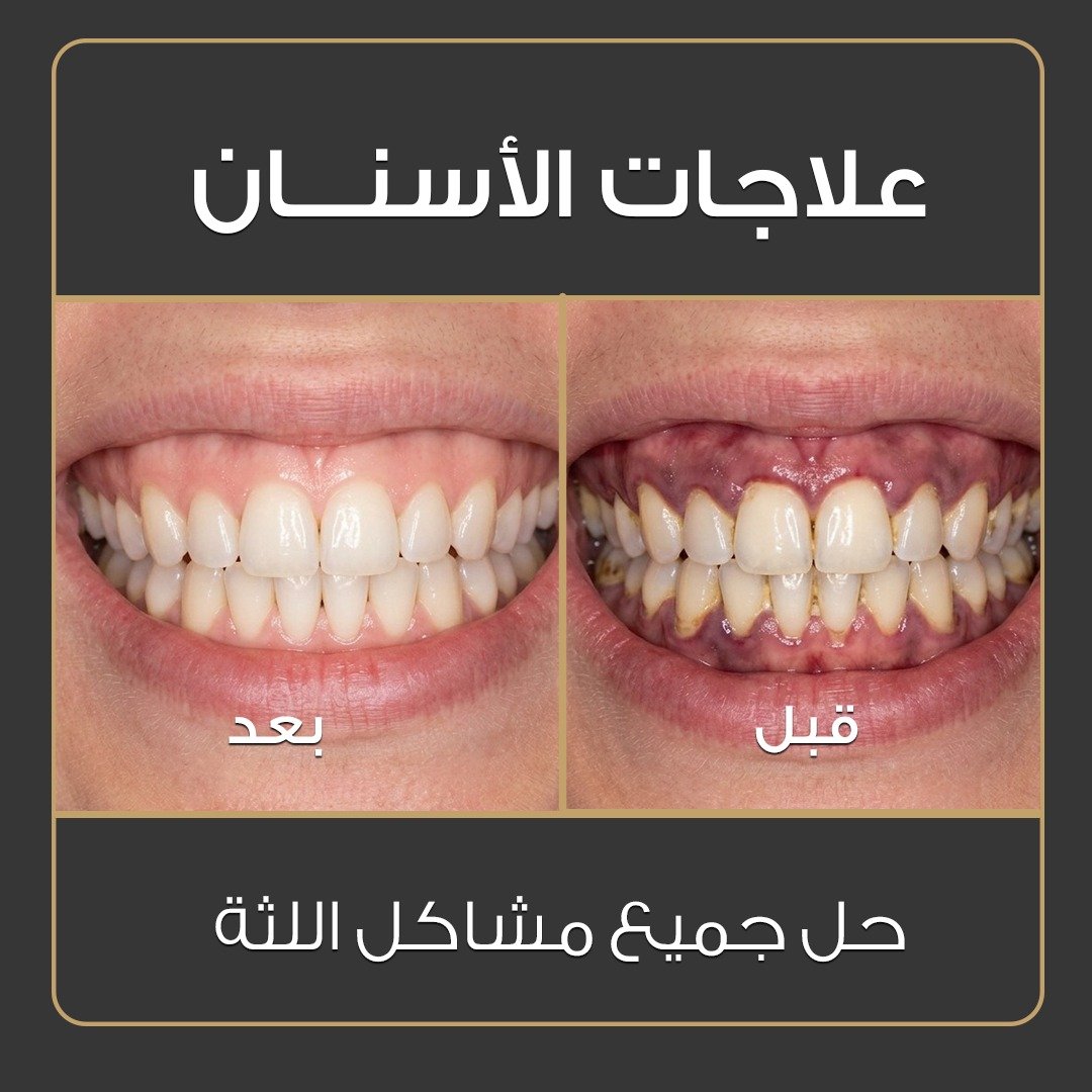 ابتسامة هوليوود - قبل وبعد - عيادة جلو أب