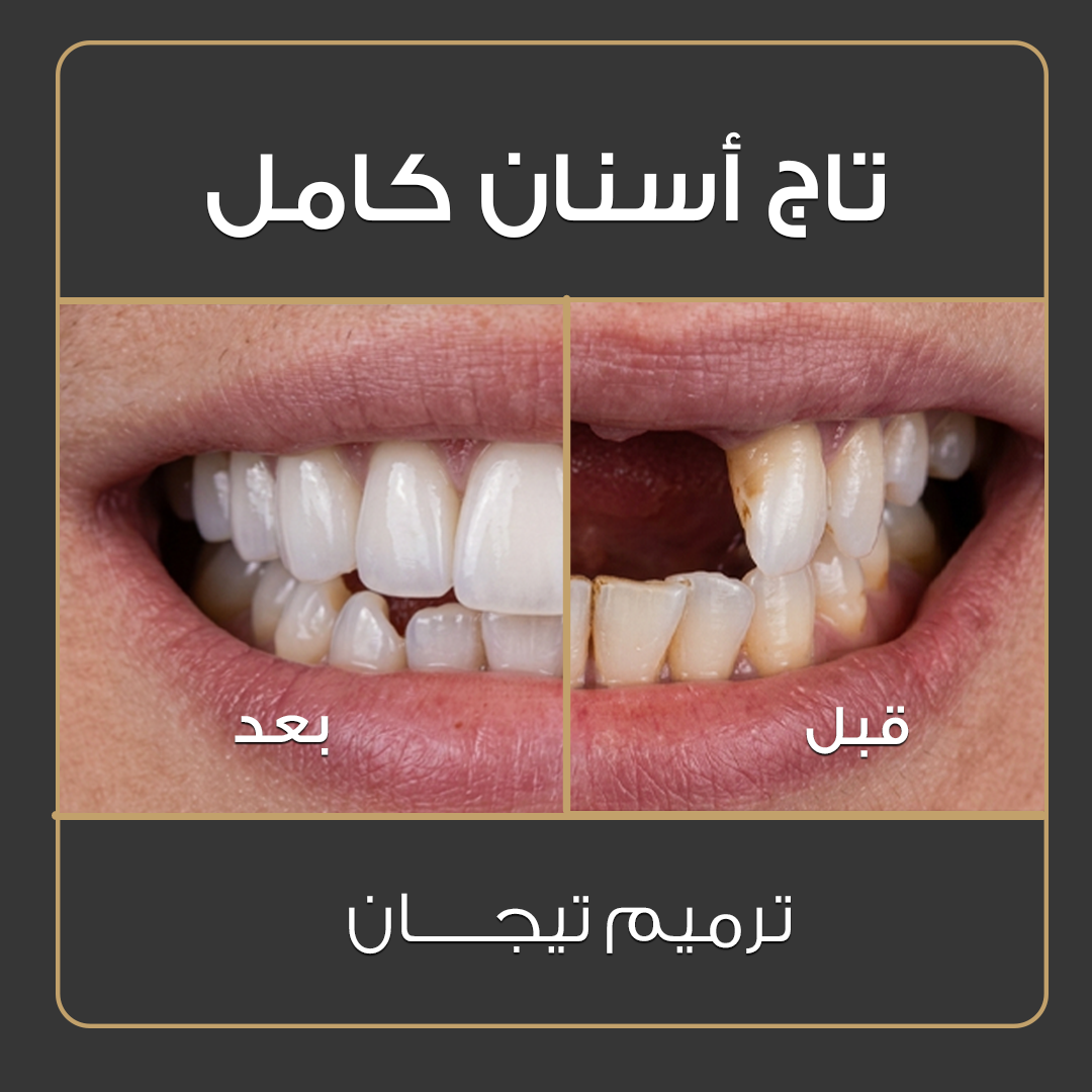 ابتسامة هوليوود - قبل وبعد - عيادة جلو أب