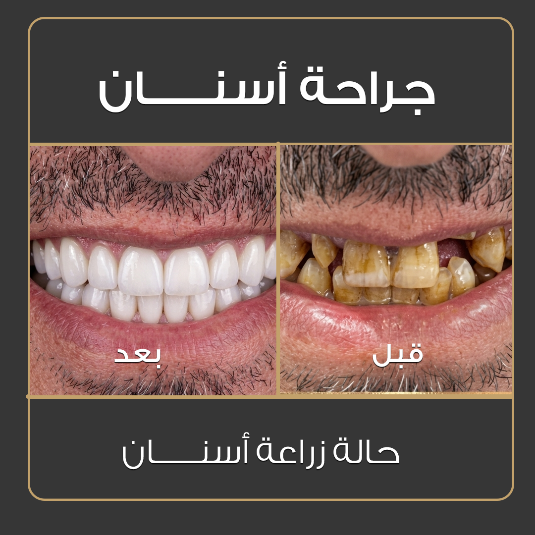 ابتسامة هوليوود - قبل وبعد - عيادة جلو أب