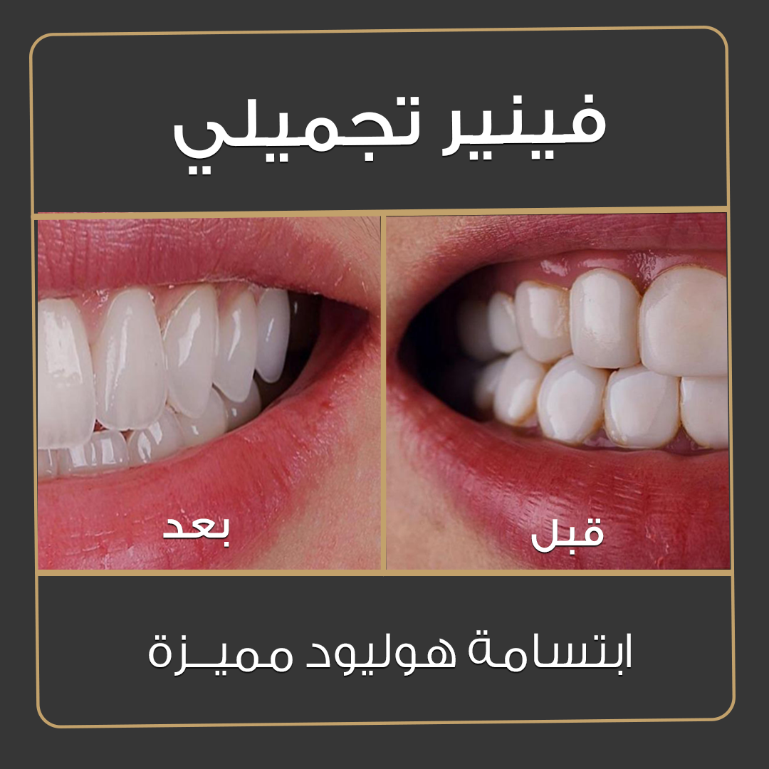 ابتسامة هوليوود - قبل وبعد - عيادة جلو أب